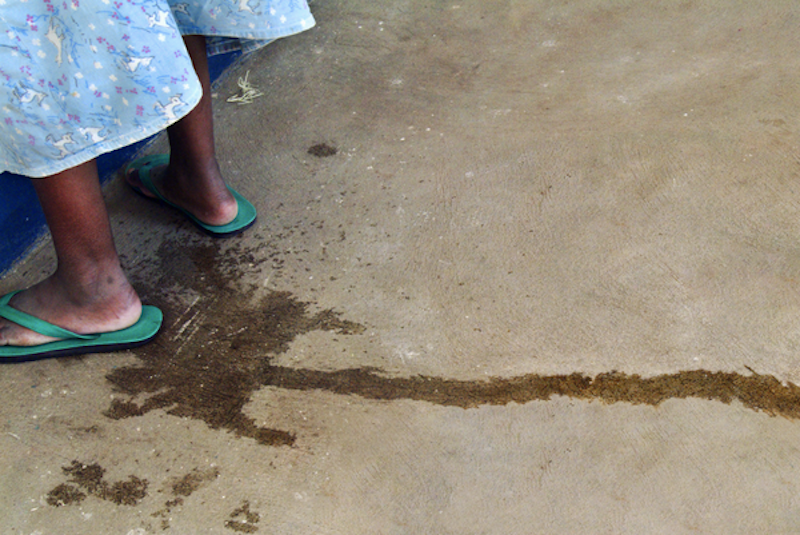 Expert calls for greater awareness on obstetric fistula