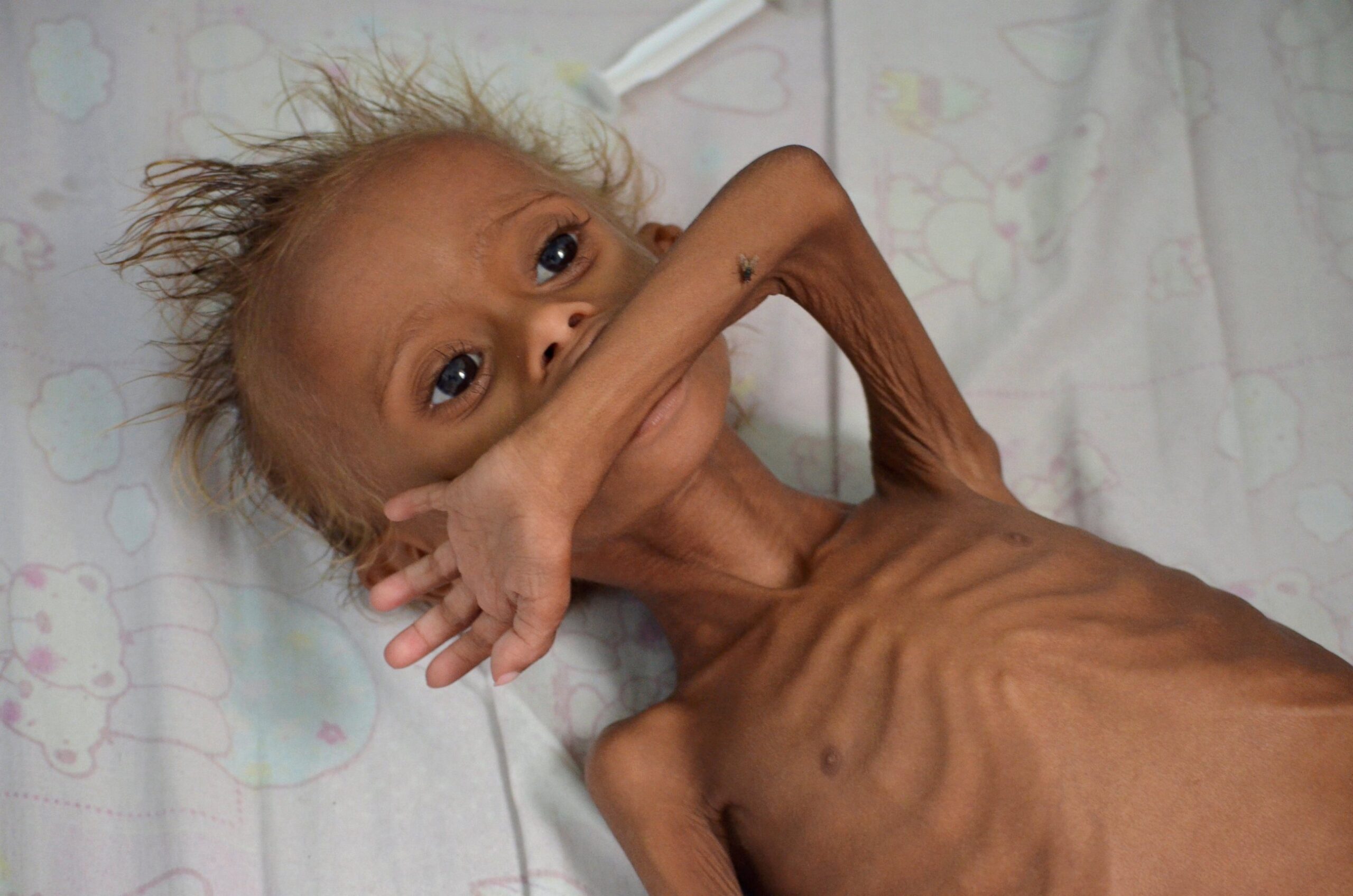 MSF laments 74.1% increase in admitted malnourished children in Kebbi
